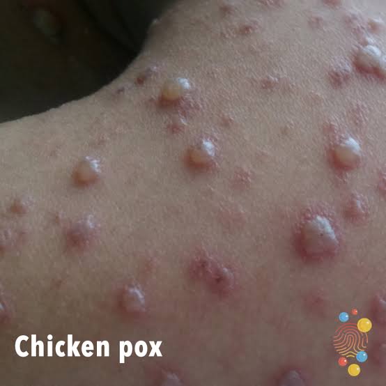 One Chickenpox Case detected in Shopian | Shaharbeen News Service ...